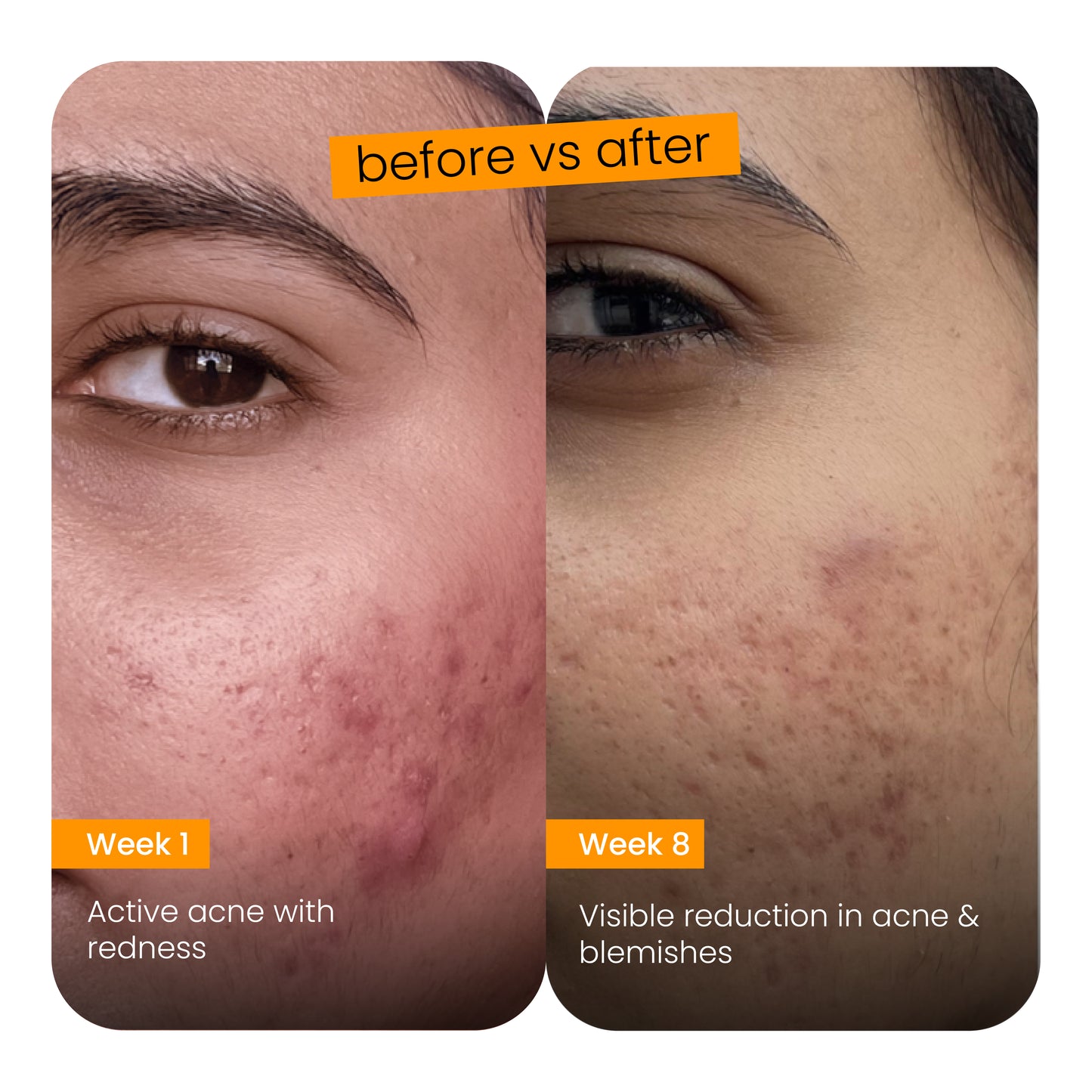 Anti-Acne clarifying serum