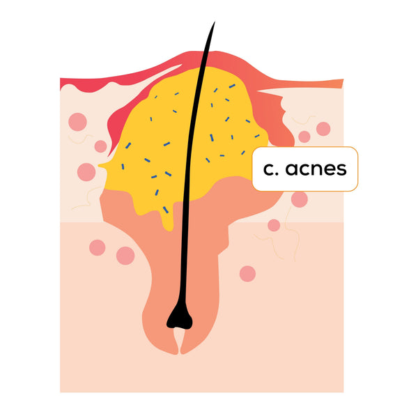 Why Acne Behaves Differently in Indian Skin