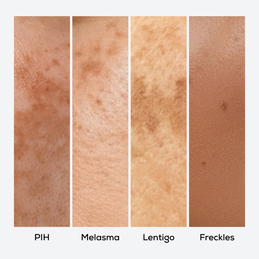The Different Types of Pigmentation Seen in Indian Skin