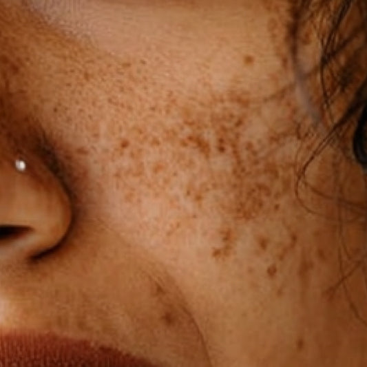Why Pigmentation in Indian Skin Is Different