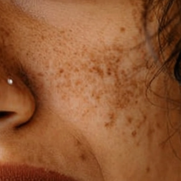 Why Pigmentation in Indian Skin Is Different