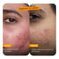 Anti-Acne clarifying serum