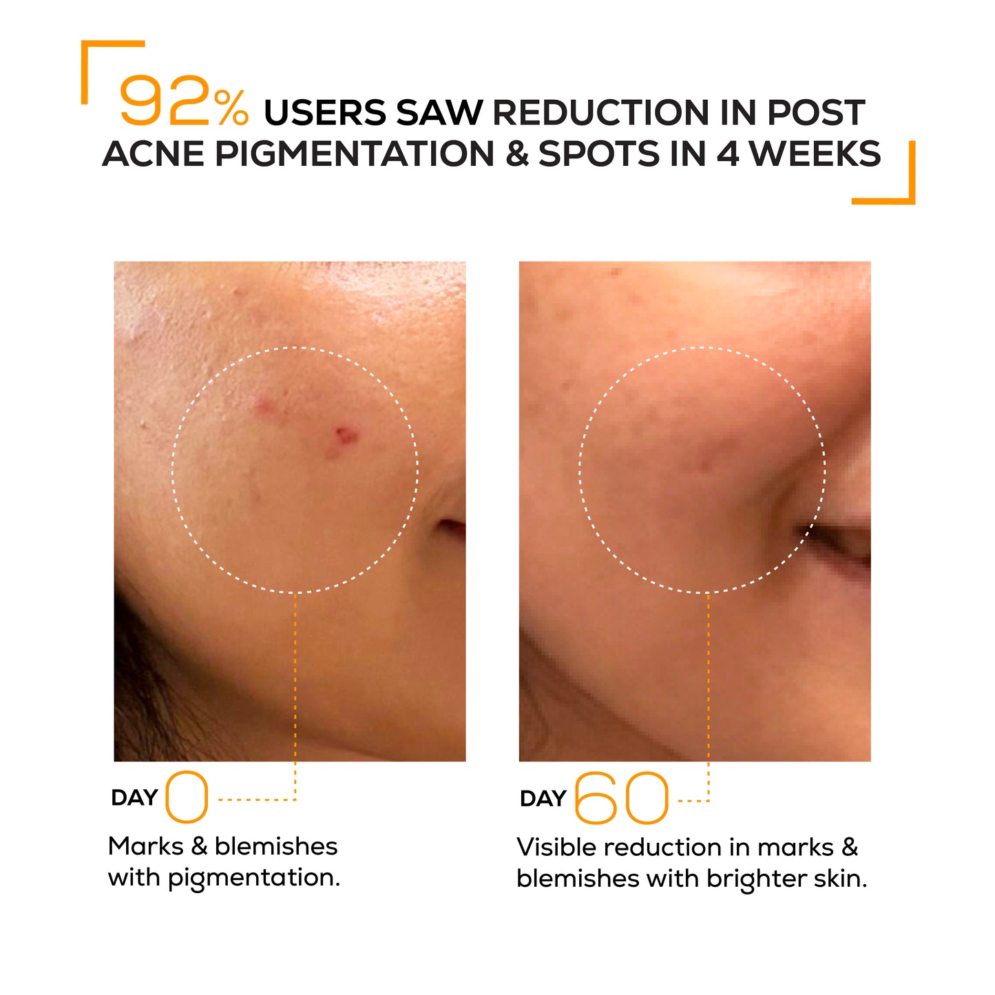 Marks & blemish reduction serum