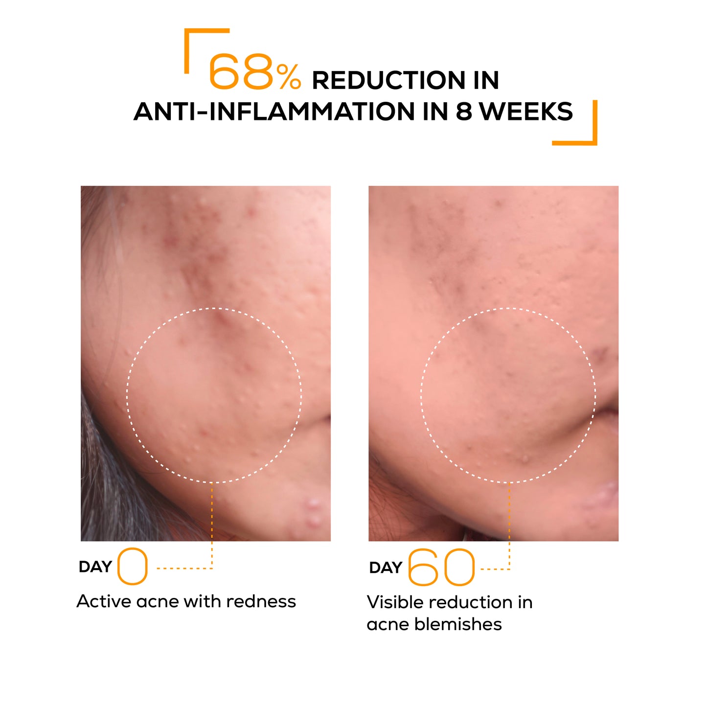 Anti-acne clarifying facewash