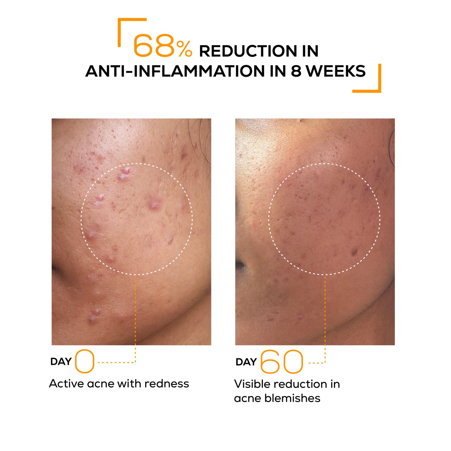 Anti-Acne clarifying serum
