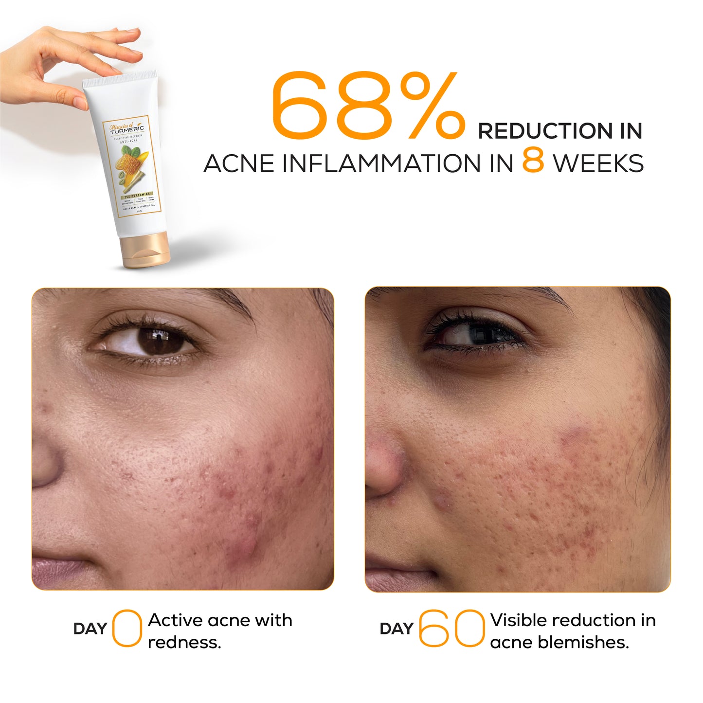 Anti-acne clarifying facewash